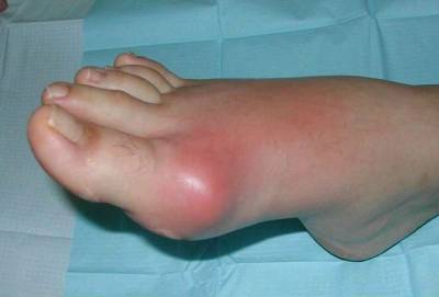 Причини за възпаление на ставите по краката и тяхното лечение