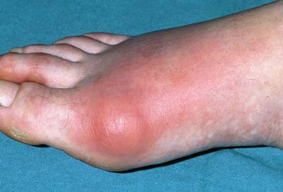 Причините за болка в ставите на краката и принципите на неговото лечение