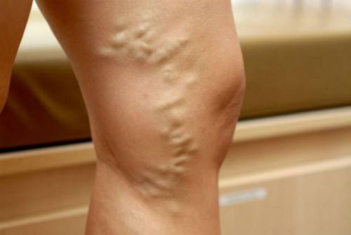 Тежест в краката под коляното и методи за лечение