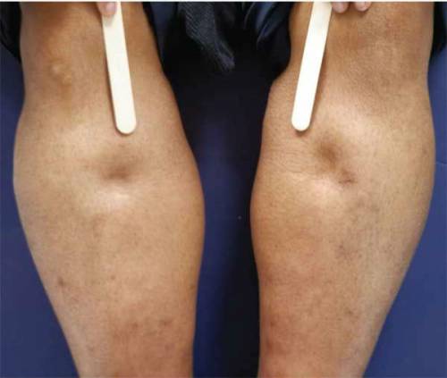 Тежест в краката под коляното и методи за лечение