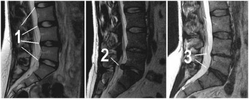 Томография на гръбначния стълб