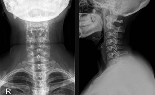 Рентгенография (роенгеннография) на цервикалния гръбначен стълб