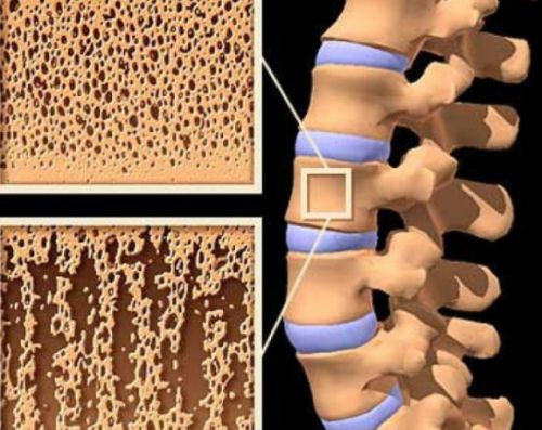 Денситометрия на гръбначния стълб