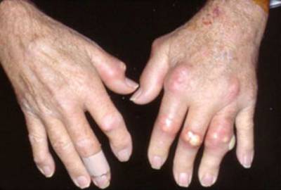Болести на ставите на пръстите на ръцете