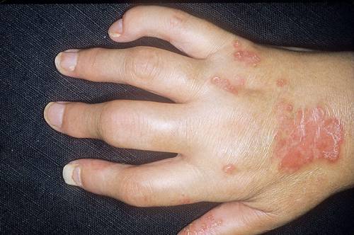 Болести на ставите на пръстите на ръцете