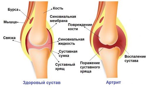 Остра болка в коляното при ходене