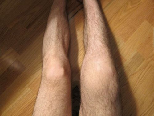 Артралгия на колянната става