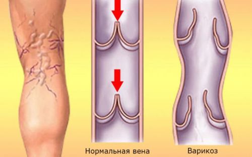 Причини и лечение на оток на коляното