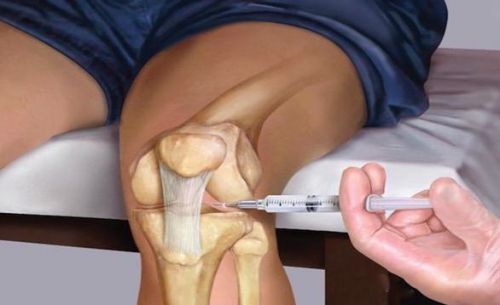Причини и лечение на оток на коляното