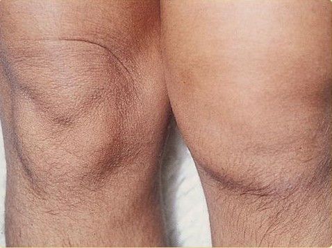 Причини и лечение на подути коляно