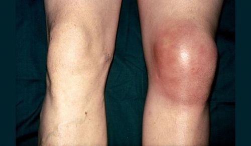 Причини и лечение на подути коляно