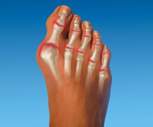 Причини за крампи на краката и тяхното лечение