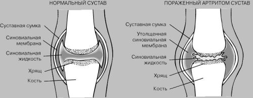 Причини за болка в колената и лактите