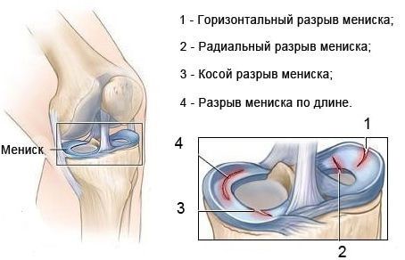 Причини за силна болка в коляното