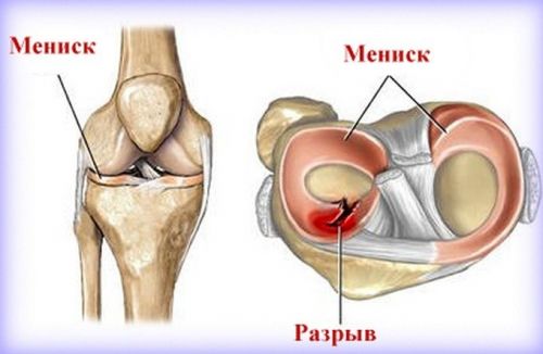 Счупване на коленете по време на флексия и удължаване