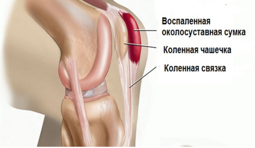 Счупване на коленете по време на флексия и удължаване