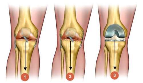 Болка и криза в ставите на коляното