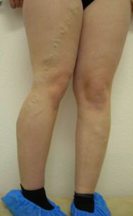 Болка в мускулите на краката над коленете и задните части