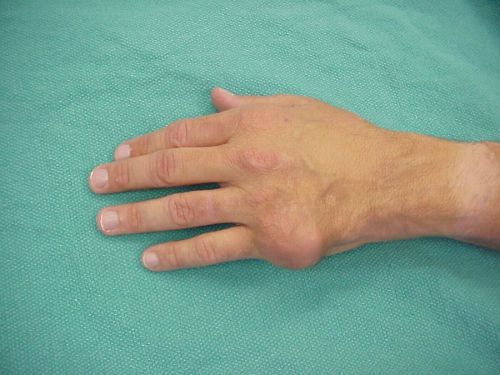 Болка в мускулите на ръцете