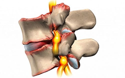 Симптомите на херния в гръбначния стълб