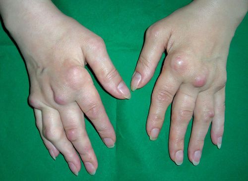 Причините за отока на пръстите