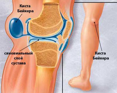 Тумори на колянната става