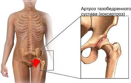 Симптоми на остеоартроза на тазобедрената става