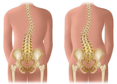 Причини за болки в гърба в скупулния регион