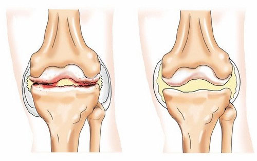Защо има болка в коляното отстрани: основните причини