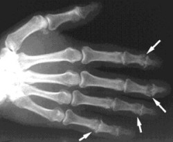 Болести на ставите на пръстите и ръцете: какво ги причинява и как да се лекуват тези заболявания