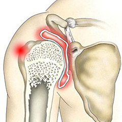 Основните причини за болката в рамото: какви заболявания причиняват и как да ги излекувате