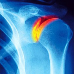 Защо има болка в раменната става? Списък на основните причини