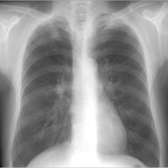 Рентгенови лъчи при бронхит. Симптоми, интерпретация на рентгенографията.