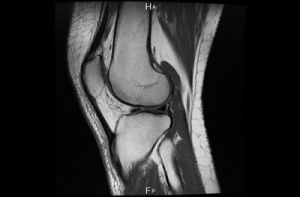 Как се показва и какво показва MRI на колянната става?