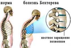 Болка в гърба над долната част на гърба: болестите, които го причиняват, и тяхното лечение