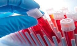 CRP в кръвта: какво е това и как да се подложи на изследването