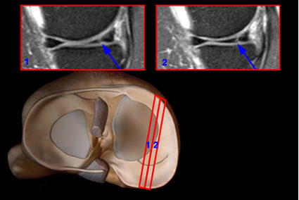 Магнитно резонансно изображение на колянната става