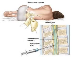 Пунктурата на гръбначния стълб: какво е необходимо, цената, къде да се подложи на процедурата в Москва
