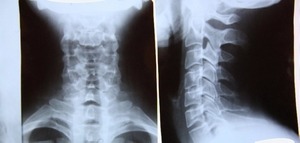 Рентгенови лъчи на гръбначния стълб: което разкрива, при какви условия се показва и как да се премине