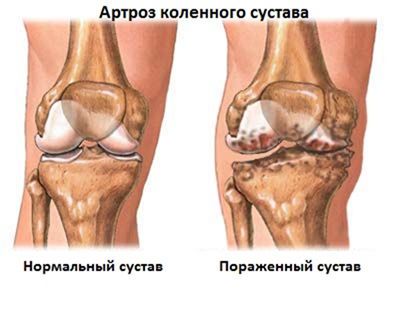 Деформиране на артрозата на колянната става (гонартроза)
