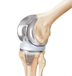 DOA (деформиращ остеоартрит) на ставите на коляното