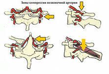Дзорпатията на лумбалния гръбначен стълб и неговото лечение