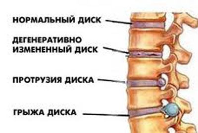 Дзорпатията на лумбалния гръбначен стълб и неговото лечение