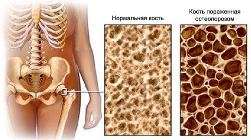 Характеристики на остеопорозата при жените и нейното лечение