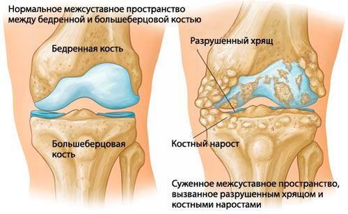 Остеоартрит на колянната става (гонартроза)