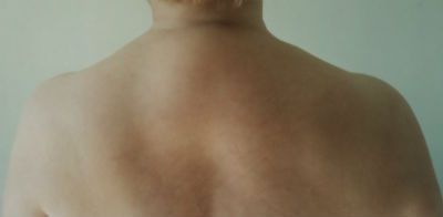 Остеопороза на различни части на гръбнака и неговото лечение