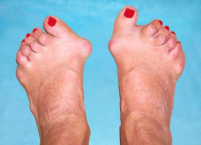Ревматоиден артрит на ръцете или краката