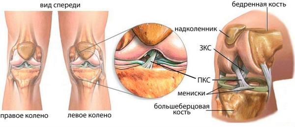 Разкъсване на предния кръстосан сухожилие (частичен или пълен)