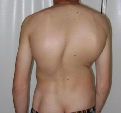 Видове кривина на гръбнака, неговите признаци и профилактика