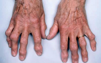 Причини за възпаление на ставите на пръстите и неговото лечение
